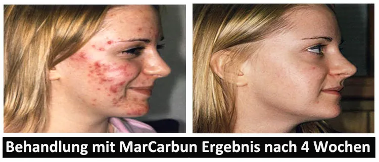 MarCarbun - Clear Skin Extrakt | Aknebehandlung - Image 3