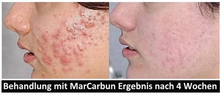 MarCarbun - Clear Skin Extrakt | Aknebehandlung - Image 2
